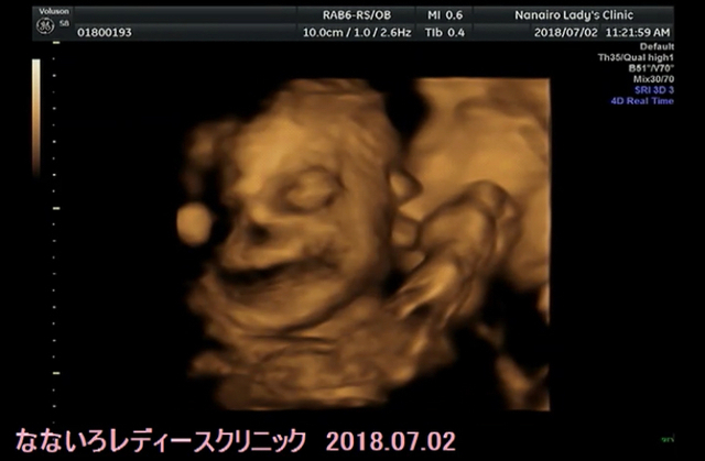 エコー写真 28週4日 28w4d 女の子,妊娠28週,エコー,