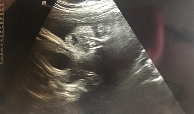 エコー写真 28週5日 28w5d 男の子,妊娠28週,エコー,
