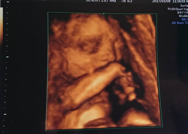 エコー写真 28週5日 28w5d 男の子,妊娠28週,エコー,