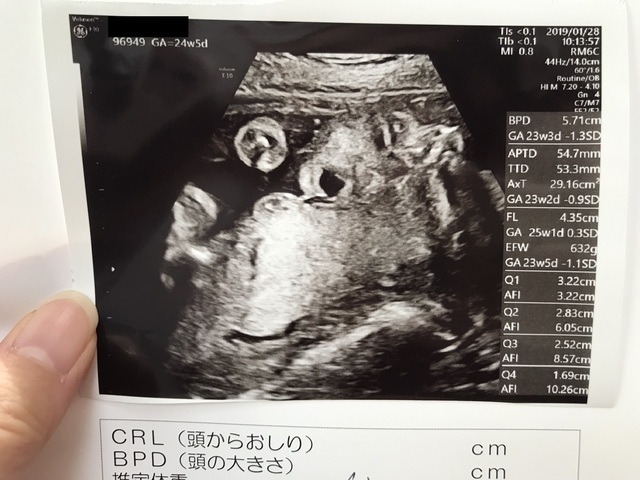 エコー写真 24週5日 24w5d 男の子,妊娠24週,エコー,