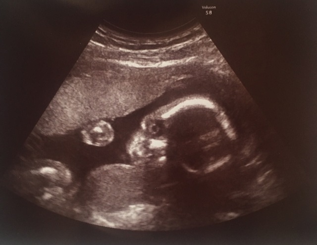 エコー写真 22週3日 22w3d 女の子,妊娠22週,エコー,