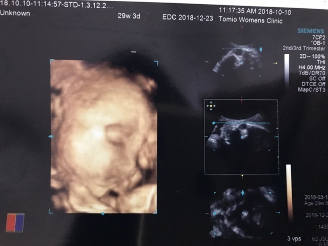 エコー写真 29週3日 29w3d 女の子,妊娠29週,エコー,