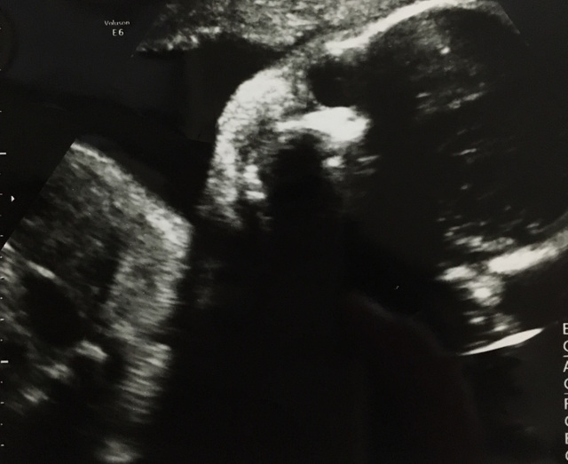 エコー写真 29週4日 29w4d 女の子,妊娠29週,エコー,