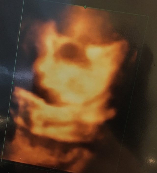 エコー写真 29週3日 29w3d 男の子,妊娠29週,エコー,