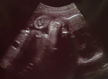 エコー写真 29週4日 29w4d 女の子,妊娠29週,エコー,