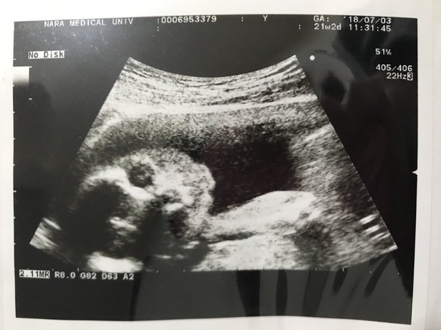 エコー写真 21週0日 21w0d 女の子,妊娠21週,エコー,