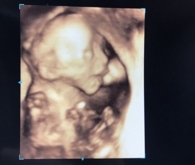エコー写真 21週5日 21w5d 女の子,妊娠21週,エコー,