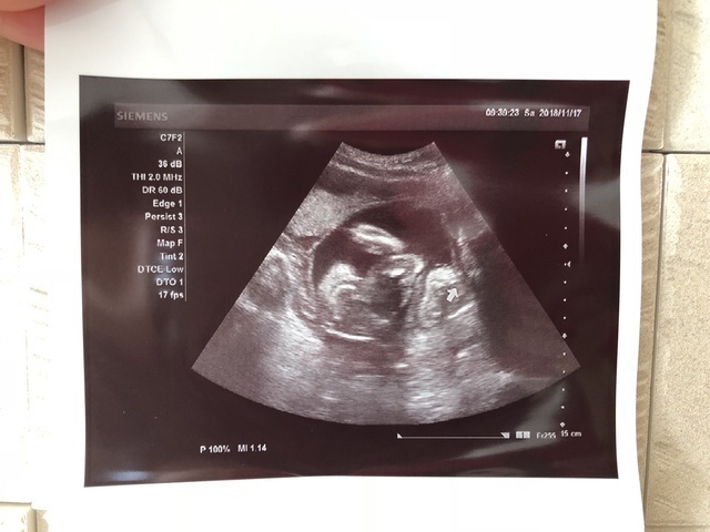 エコー写真 21週6日 21w6d 男の子,妊娠21週,エコー,