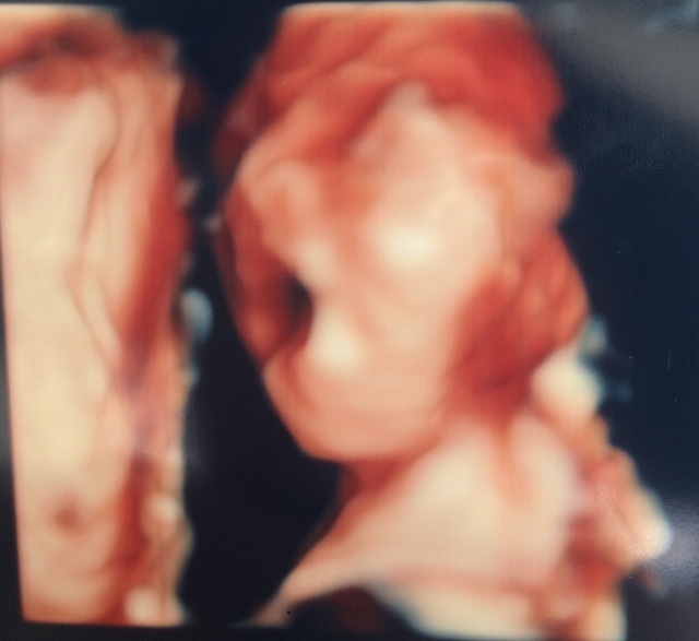 エコー写真 21週0日 21w0d /男の子,妊娠21週,エコー,
