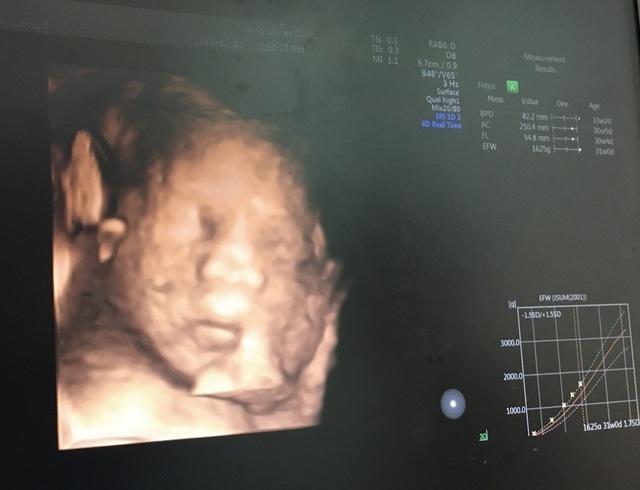 エコー写真 31週0日 31w0d 男の子,妊娠,31週,エコー写真