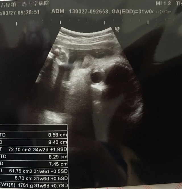 エコー写真 31週0日 31w0d 男の子,妊娠,31週,エコー写真