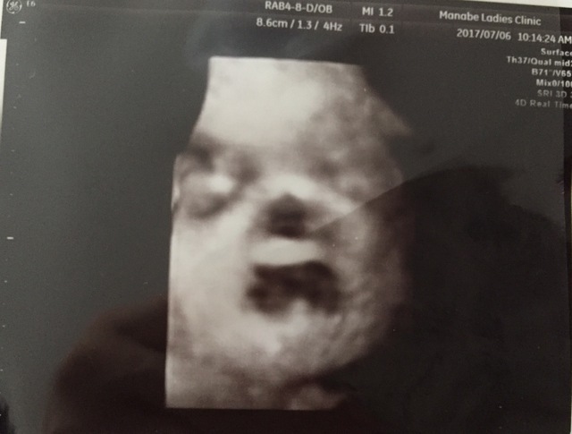 エコー写真 31週0日 31w0d 男の子,妊娠,31週,エコー写真