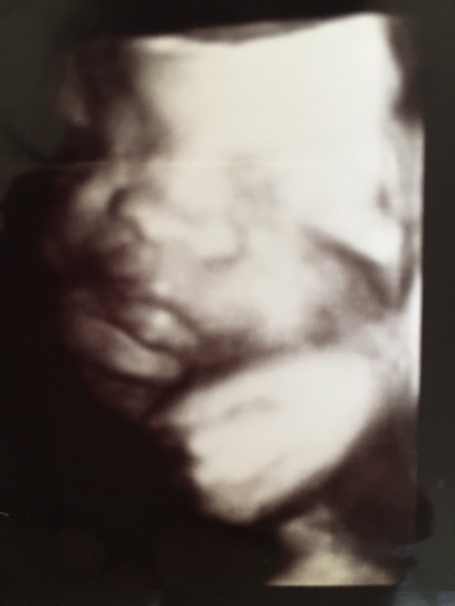 エコー写真 31週1日 31w1d 女の子,妊娠,31週,エコー写真