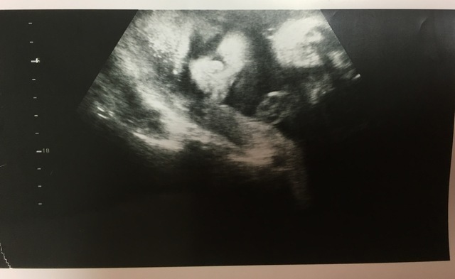 エコー写真 31週6日 31w6d 男の子,妊娠,31週,エコー写真