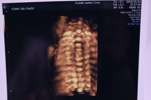 エコー写真 31週2日 31w2d 女の子,妊娠,31週,エコー写真