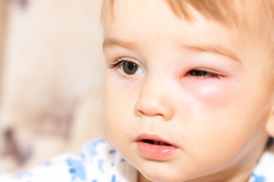 子連れでおでかけし、蚊に刺されて腫れてしまった際の対処法