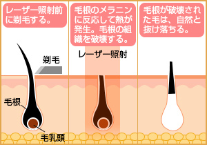 医療脱毛でvio脱毛したいでも実際かかる回数って安城