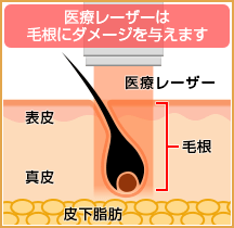 医療レーザー脱毛は毛根にダメージを与えます