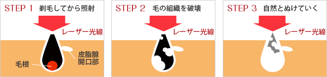 医療レーザー脱毛の仕組み