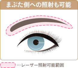 当クリニックの眉毛脱毛範囲