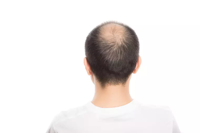 2025年薄毛のお悩み　隠すより活かす!?