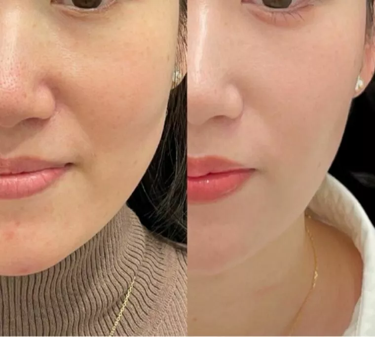 ３０代男性におすすめ！monが受けてる美容医療