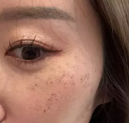 神戸結婚相談所ルートマリッジ「３０代男性におすすめ！monが受けてる美容医療」- 2