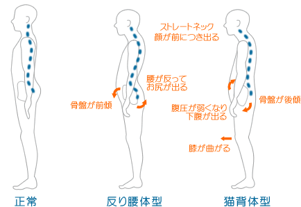 猫背と反り腰解説、町田・相模大野・古淵の整骨院