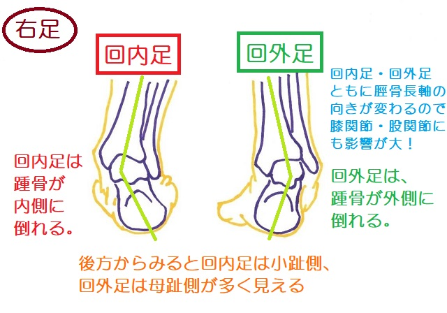 回内足、オーバープロネーション