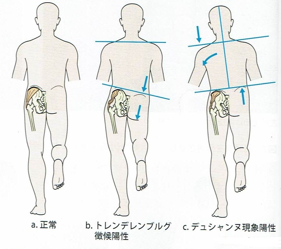 トレンデレンブルグ徴候、デュシャンヌ歩行