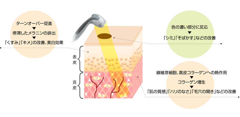 ライムライトの治療効果と特徴