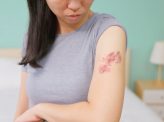 身近に忍び寄る帯状疱疹の恐怖