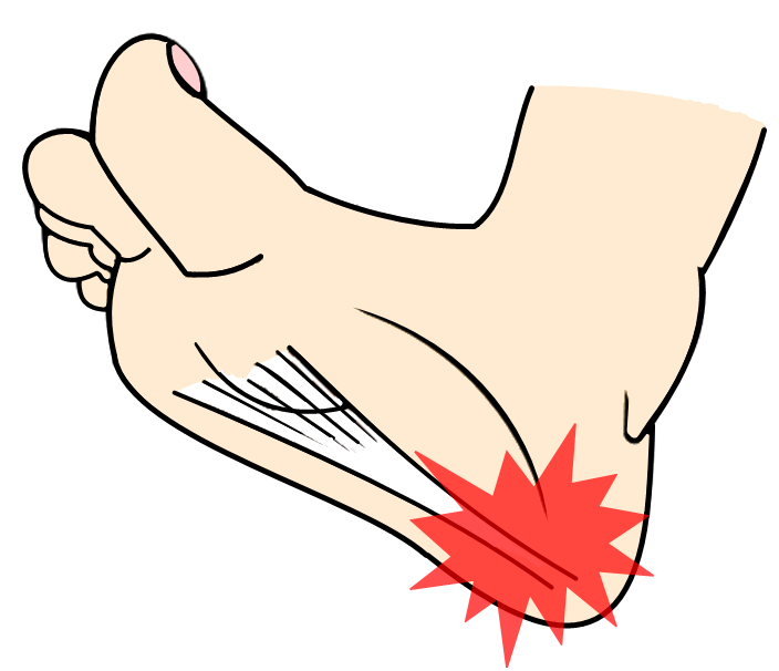 因為彈性不足而引發「足底筋膜炎」時，應該先停止運動。（圖片來源：李炎諭醫師提供）