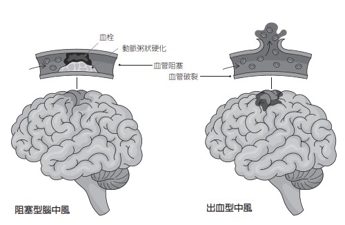 腦中風