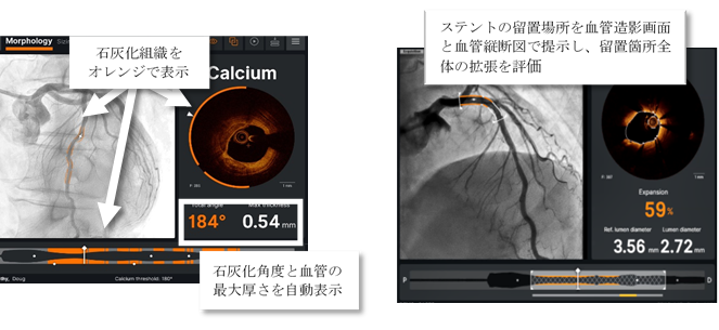 アボット 国内初のaiを搭載した循環器oct画像診断装置用 Ultreon Tm 1 0 ソフトウェアを発売 Ledge Ai
