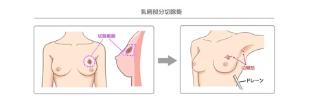 外科医が修得すべき 乳がん手術 | 大野 真司 |本 | 通販 | Amazon