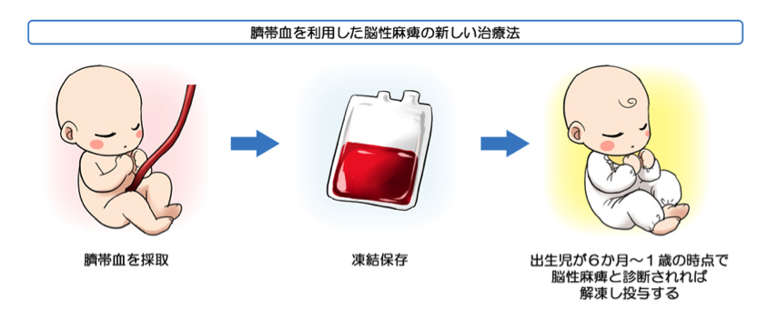 ヒト臍帯血幹細胞輸血治療