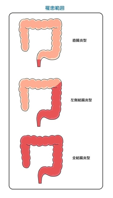 IBD（炎症性腸疾患の罹患範囲）