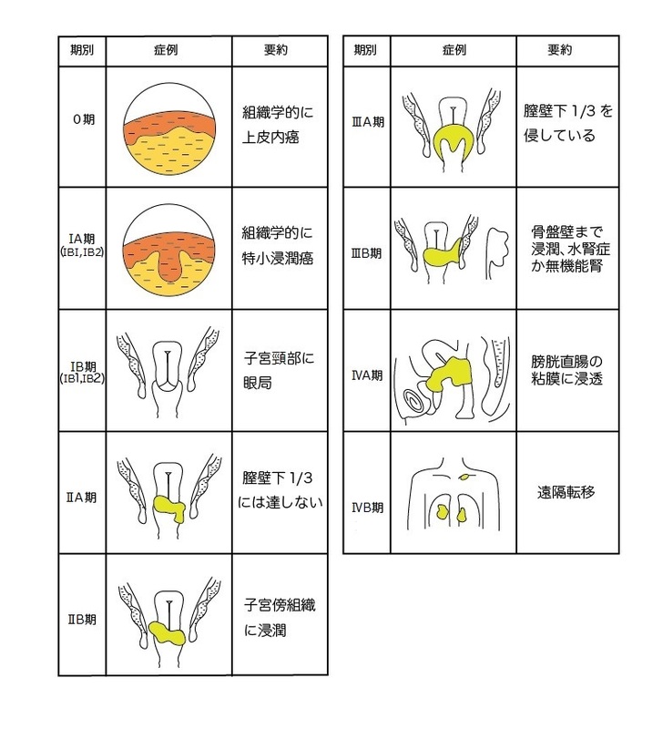 子宮頚部腫瘍の診断と治療 (今日の治療) 森 崇英 子宮頸がん：子宮頸部異形成から浸潤がんの診断と治療 - YouTube
