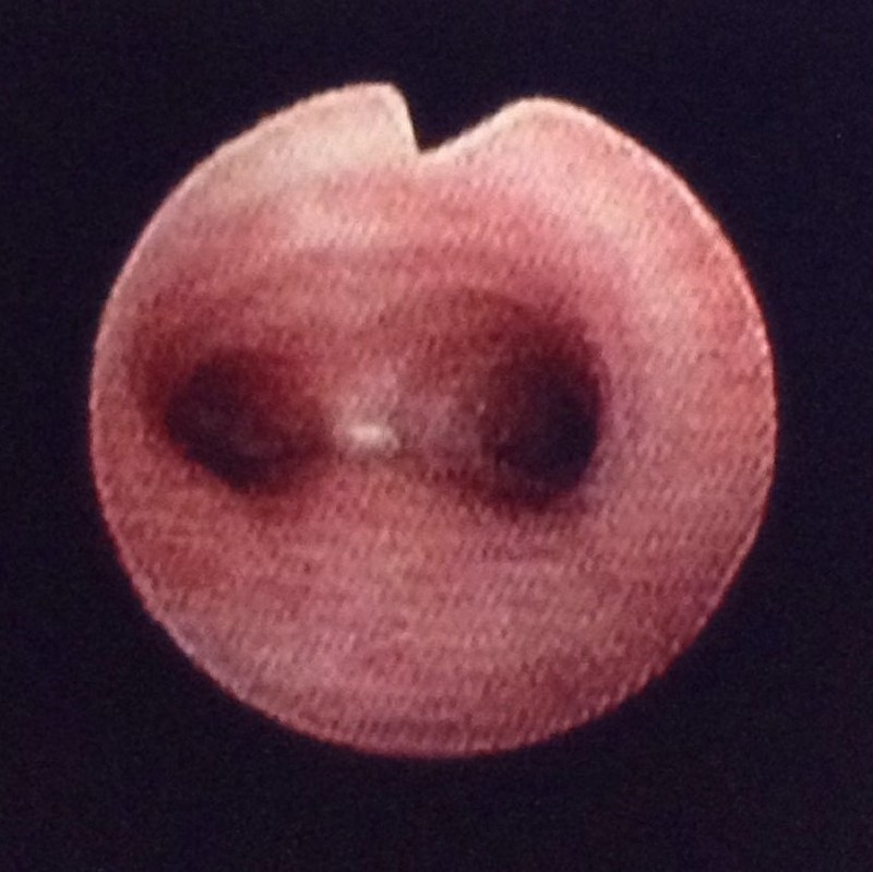 気管から期間分岐部