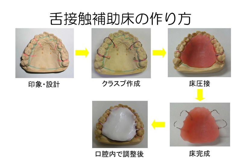 舌接触補助床作成画像