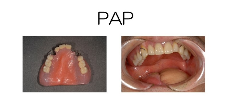ＰＡＰ装着イメージ