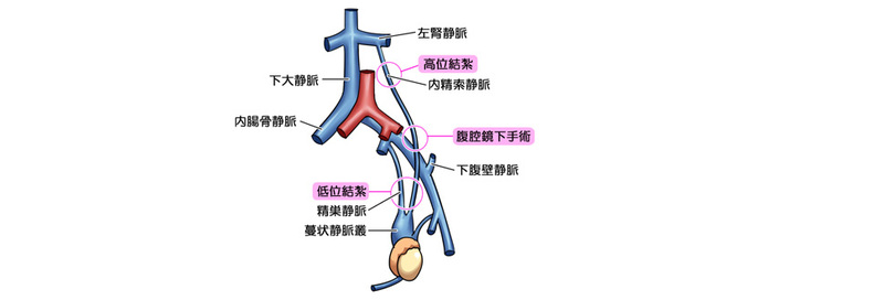 精索静脈瘤の低位結紮術
