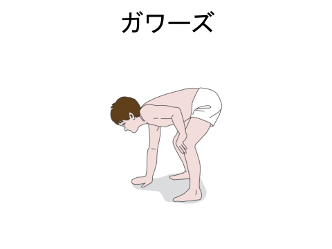 ガワーズ兆候のイラスト