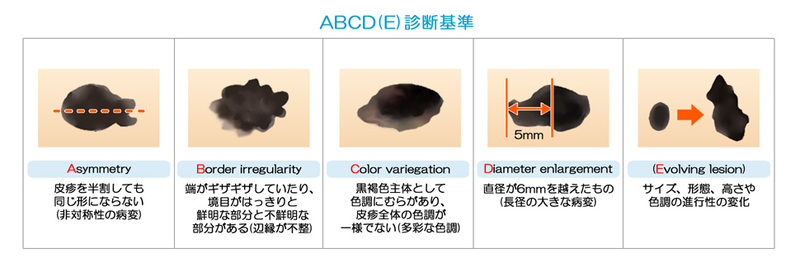 メラノーマのABCDE