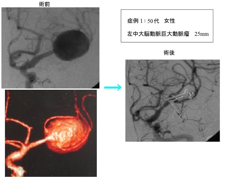 巨大動脈瘤の症例1：50代女性　頭痛の精査で発見された　左中大脳動脈巨大動脈瘤 25mm