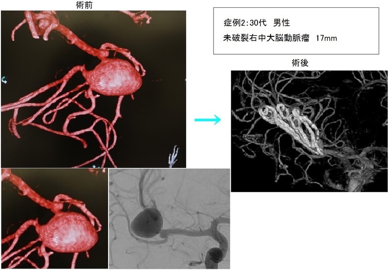 巨大動脈瘤の症例2：30代男性　大型右中大脳動脈瘤 17mm