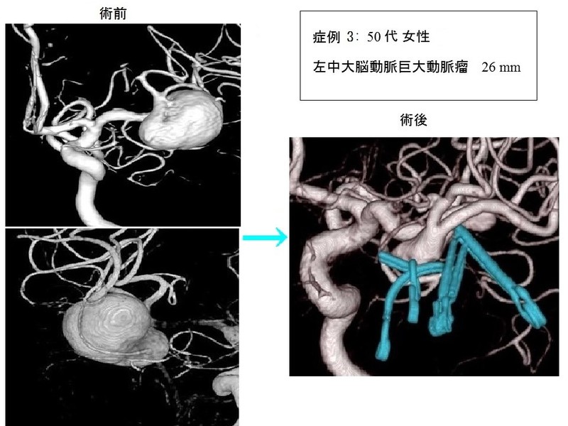 巨大動脈瘤の症例3：50代女性　巨大左中大脳動脈瘤  26mm