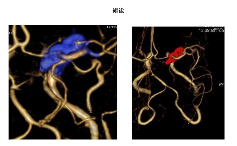 脳動脈瘤クリッピング術―血管内治療が困難な動脈瘤 | メディカル