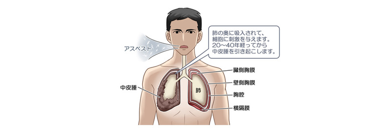 アスベストが体に吸引される仕組み